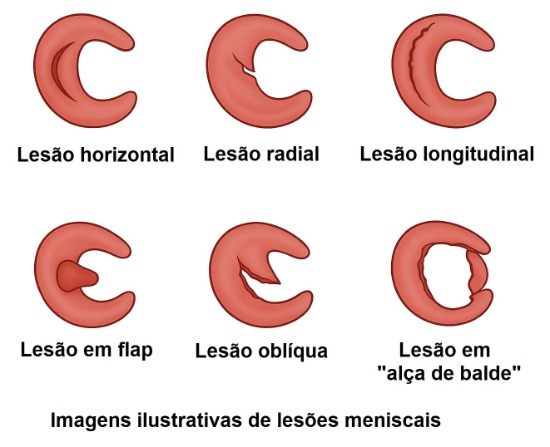 Lesões de menisco.jpg